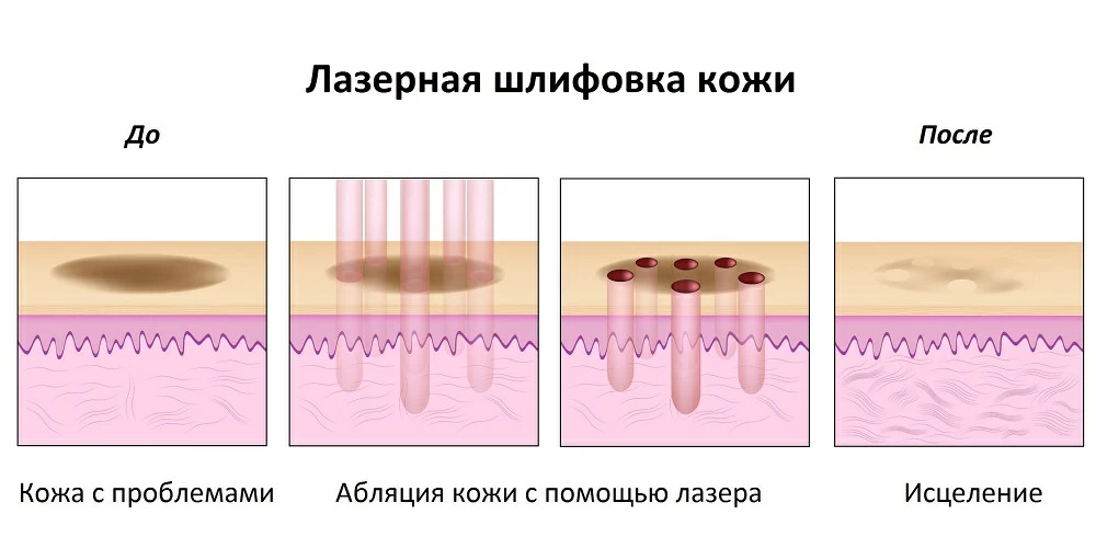  Лазерная шлифовка кожи 